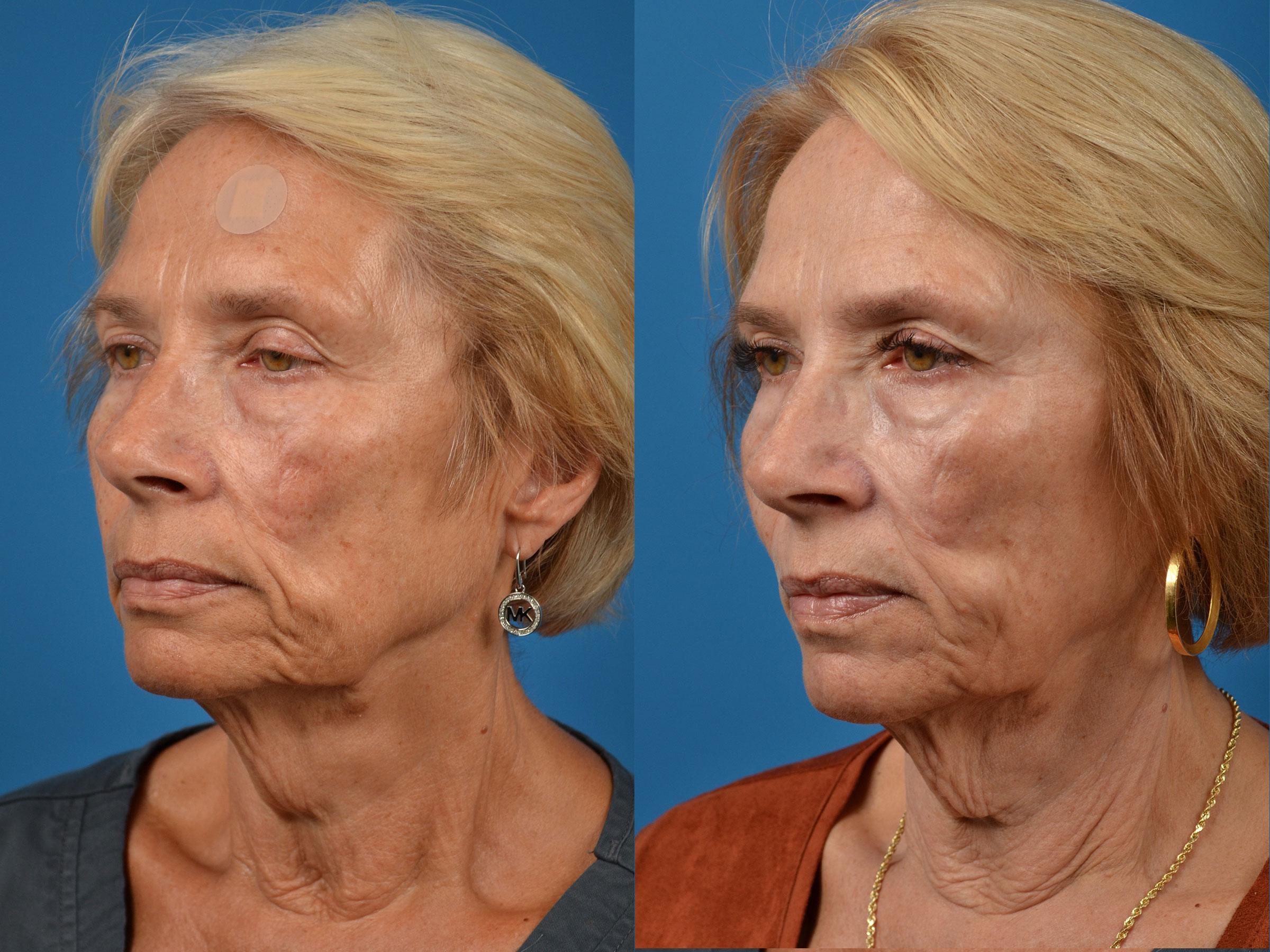 Mohs Surgery And Skin Cancer Photos Melbourne Fl Patient 55412